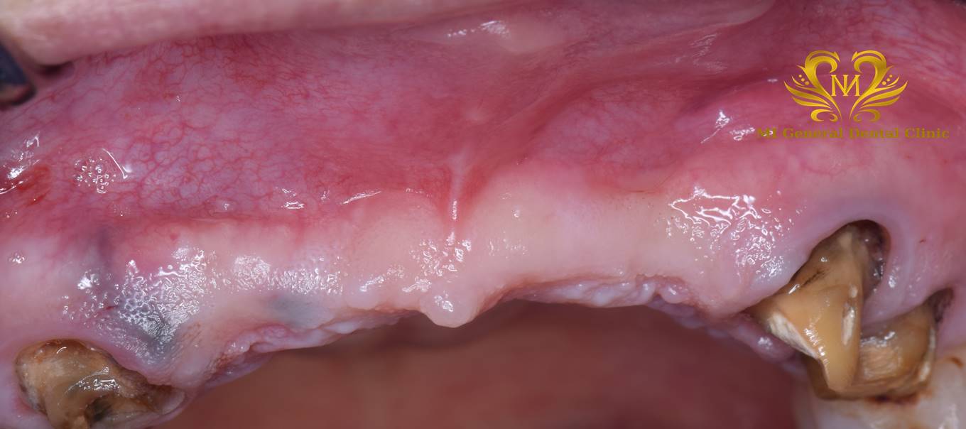 前歯の多数歯欠損のインプラント症例